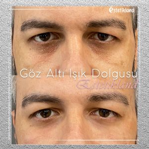 göz altı ışık dolgu