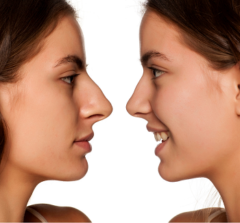 rinoplasty in turkey
