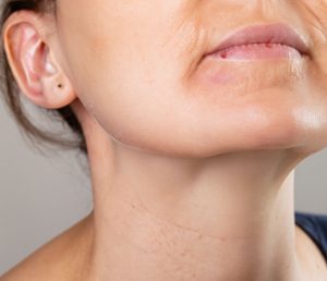 kybella