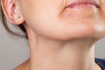 kybella