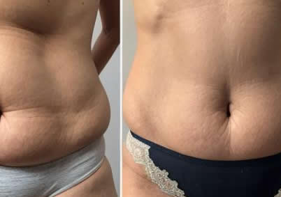 tummy tuck