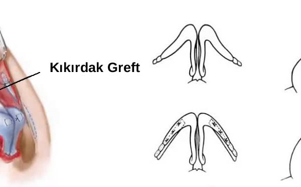 kıkırdak greft