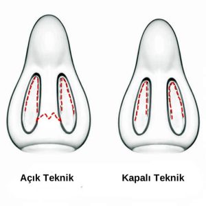 açık ve kapalı burun estetiği