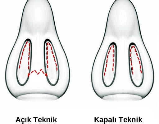 açık ve kapalı burun estetiği